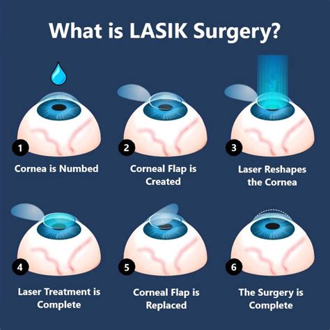LASIK .